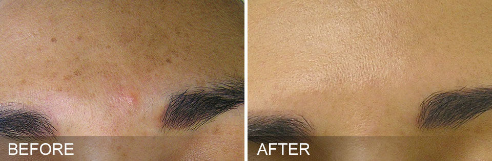 A-New-You-Dbq-Spa-HydraFacial-before-after-BrownSpots-1872x614x0x0x1872x614x1638314657