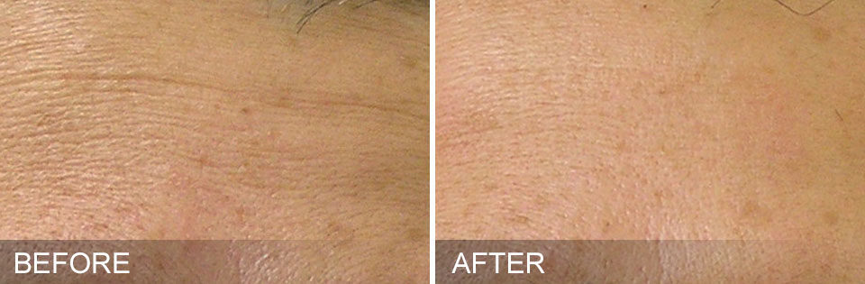A-New-You-Dbq-Spa-HydraFacial-before-after-FineLinesjpg-1872x614x0x0x1872x614x1638314658