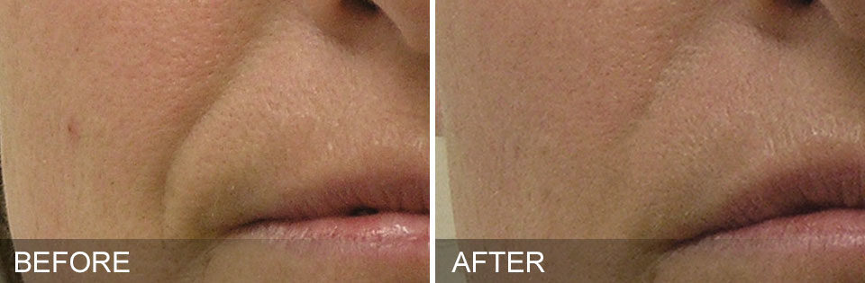 A-New-You-Dbq-Spa-HydraFacial-before-after-NasolabialFolds-1872x614x0x0x1872x614x1638314659