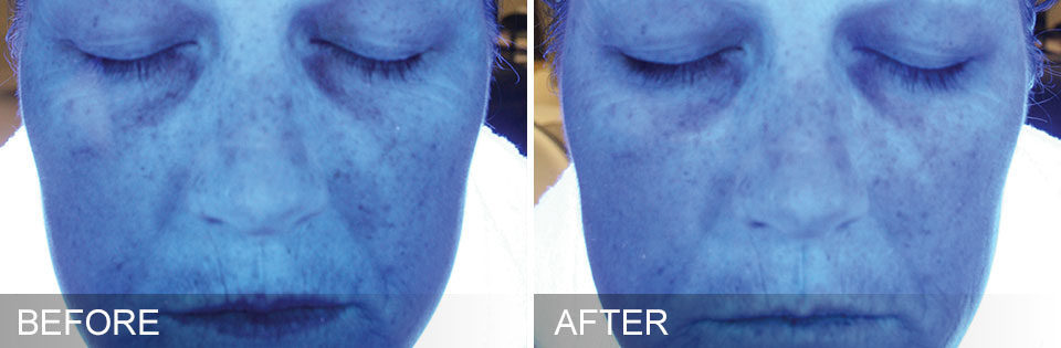 A-New-You-Dbq-Spa-HydraFacial-before-after-hydration-1872x614x0x0x1872x614x1638314659